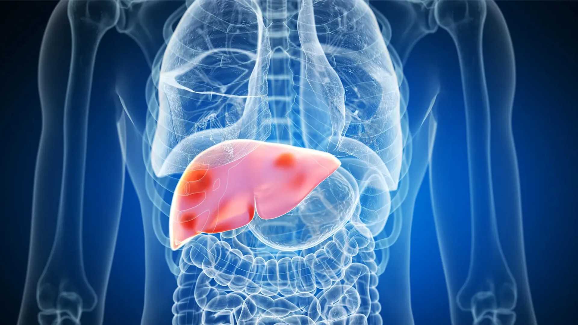 How ChatGPT is Helping Adults with Liver Disease