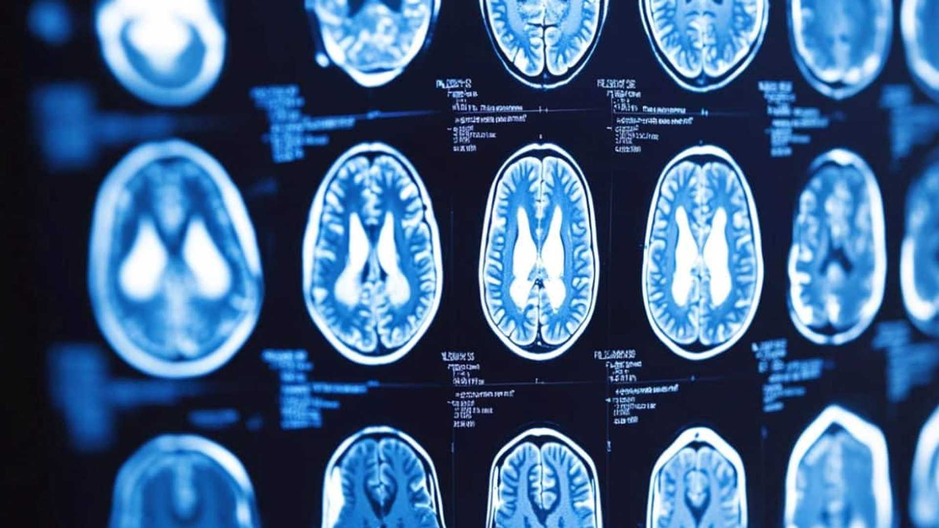 Can ChatGPT Replace Radiologists in Brain Tumor Diagnosis? A 73% Accuracy Study