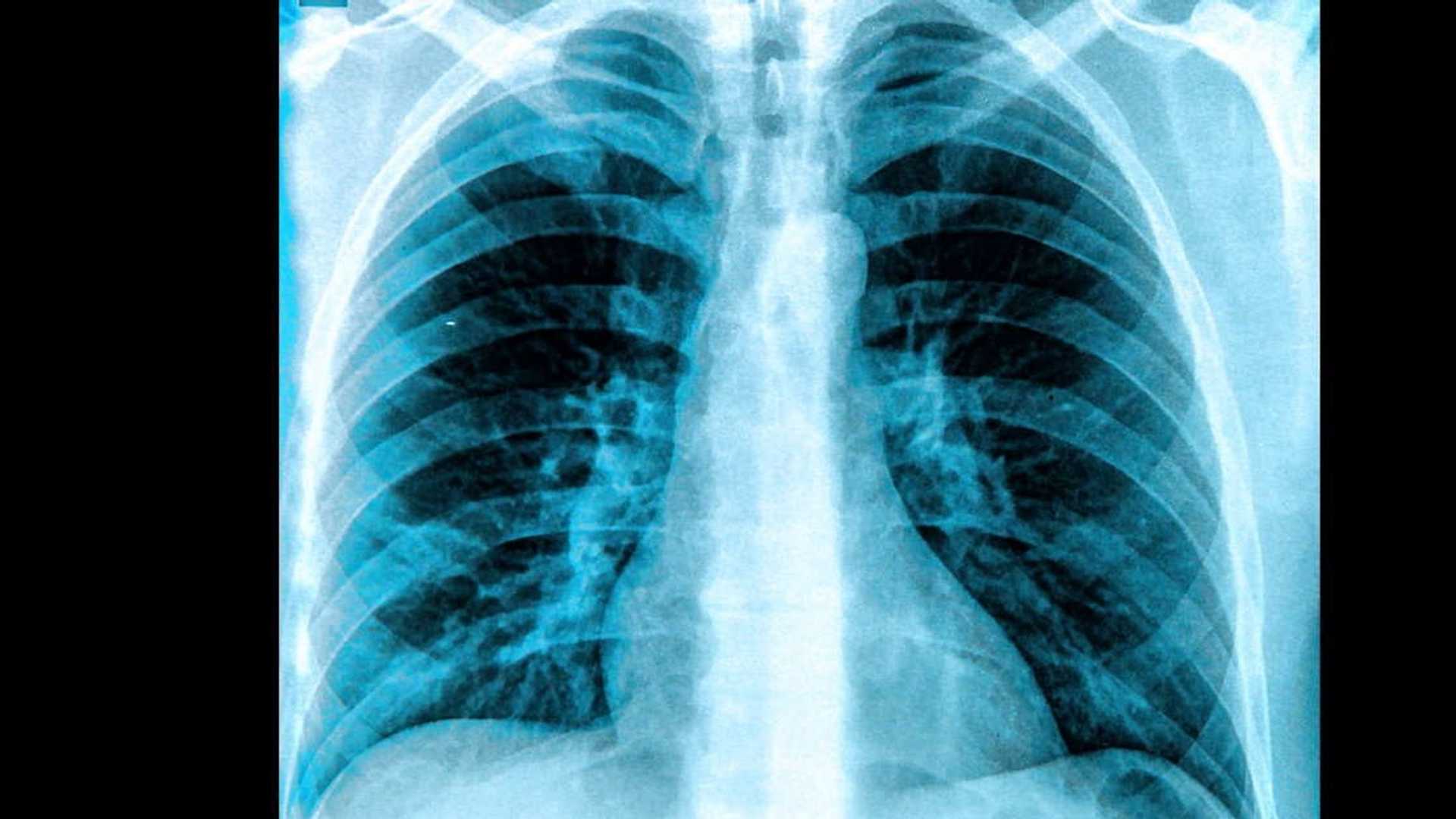 Revolutionizing Radiology: ChatGPT-4's Accuracy Examined